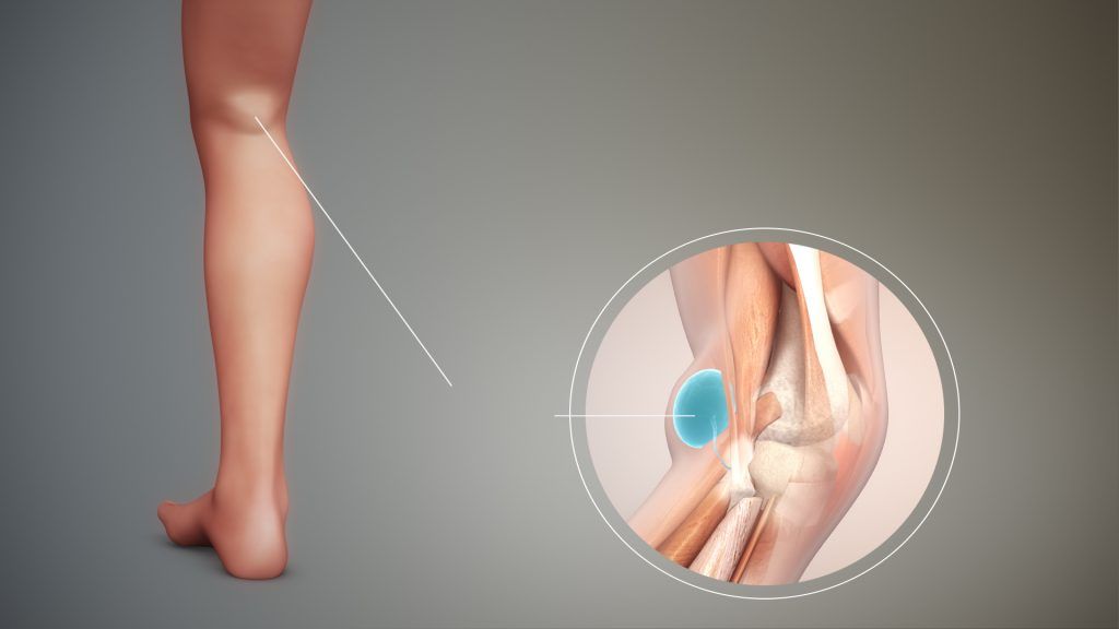 leg to the left of the image with the lump, to the right blue lump on the back of the knee showing Baker's cyst