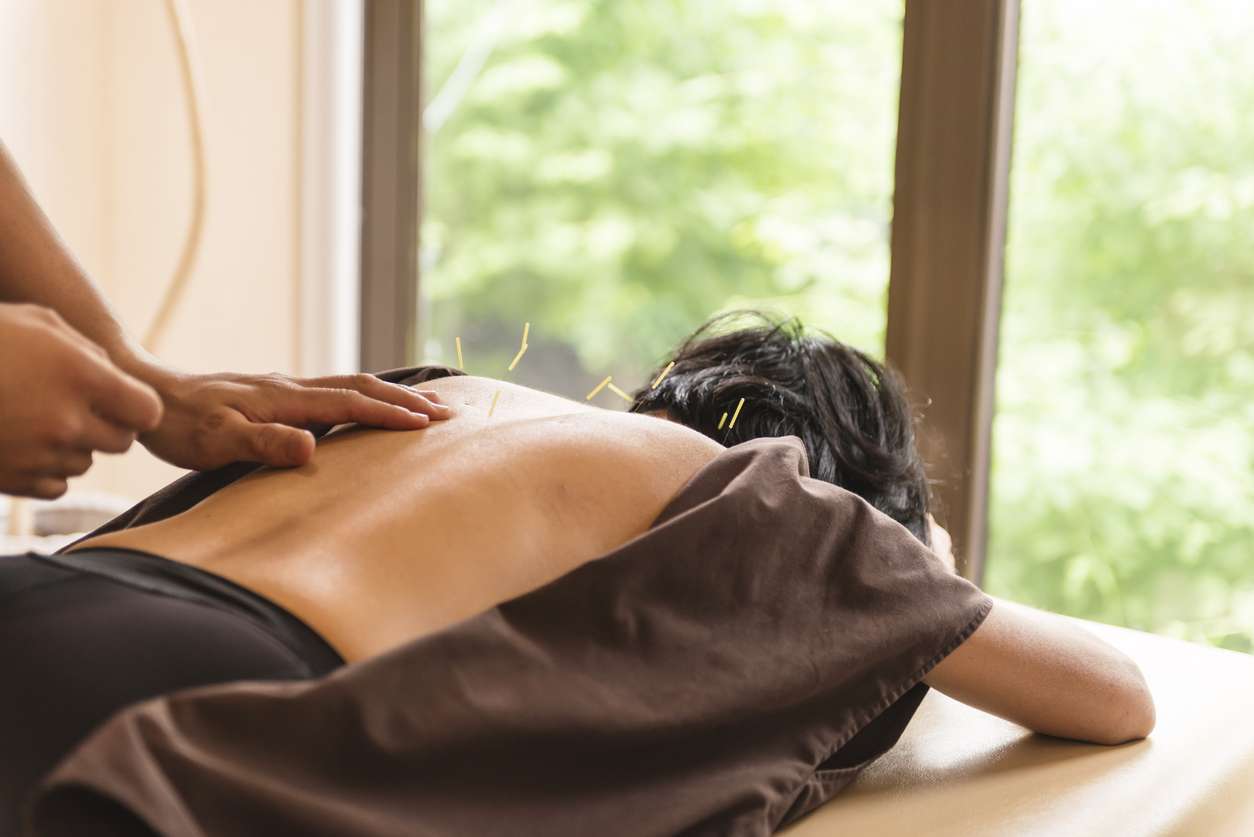 Young woman, Japanese ethnicity, at the acupuncture treatment. Hands of acupuncturists inserting needles in her back. She lies, waist up, at bright window.